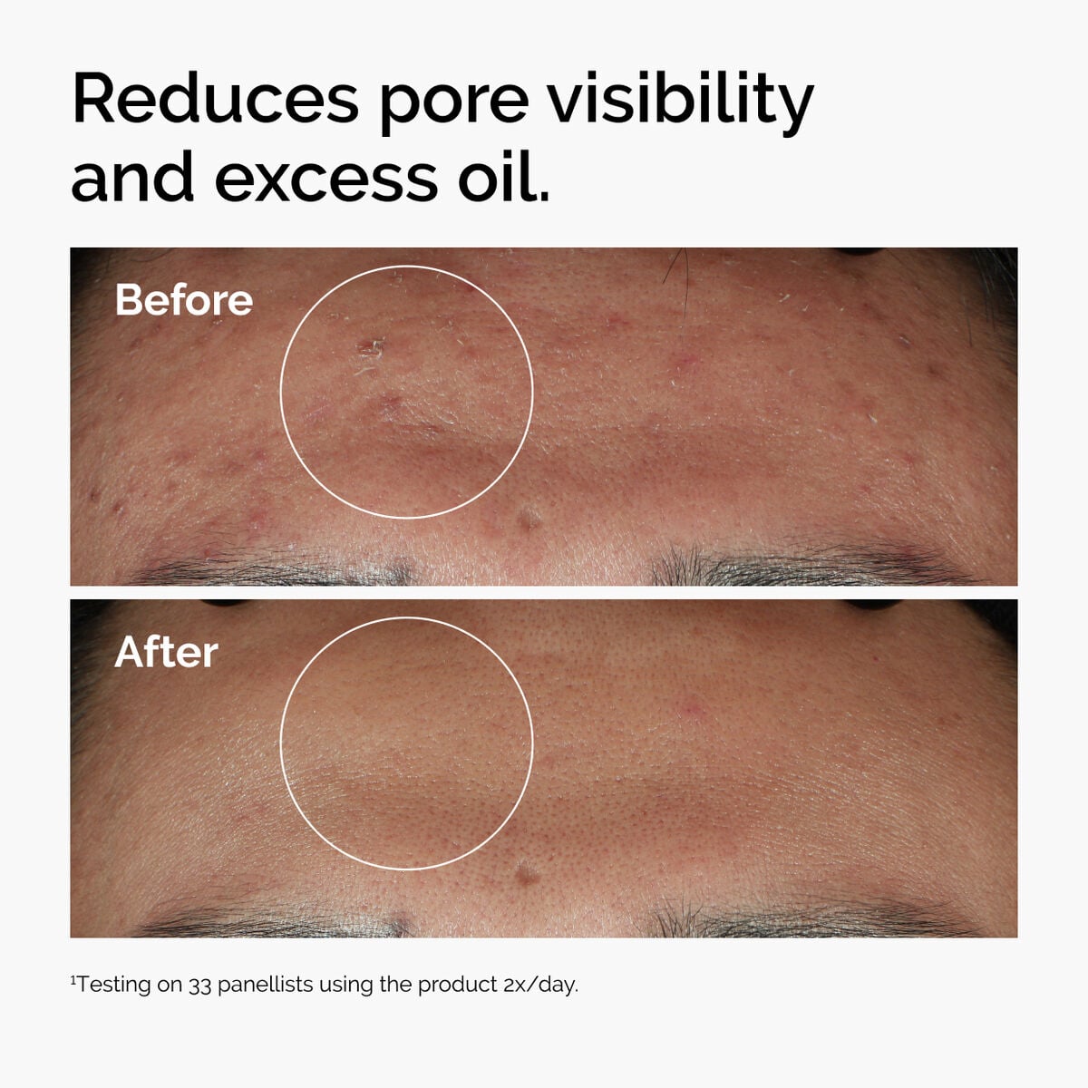 niacinamide-10-zinc-1-r1 ord-niacinamide-zinc-blemish-serum-before-after-pores.jpg