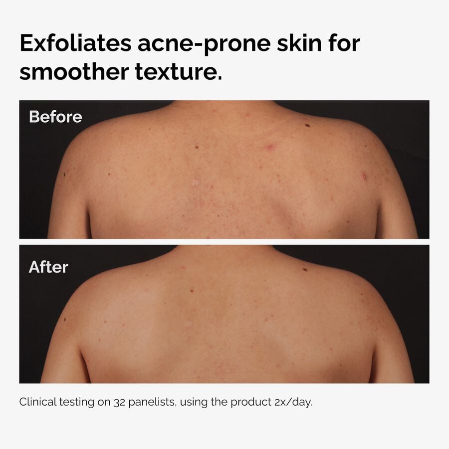 the-body-care-collection-n4 ord-salicylic-acid-body-serum-before-after-graphic-NA.jpg