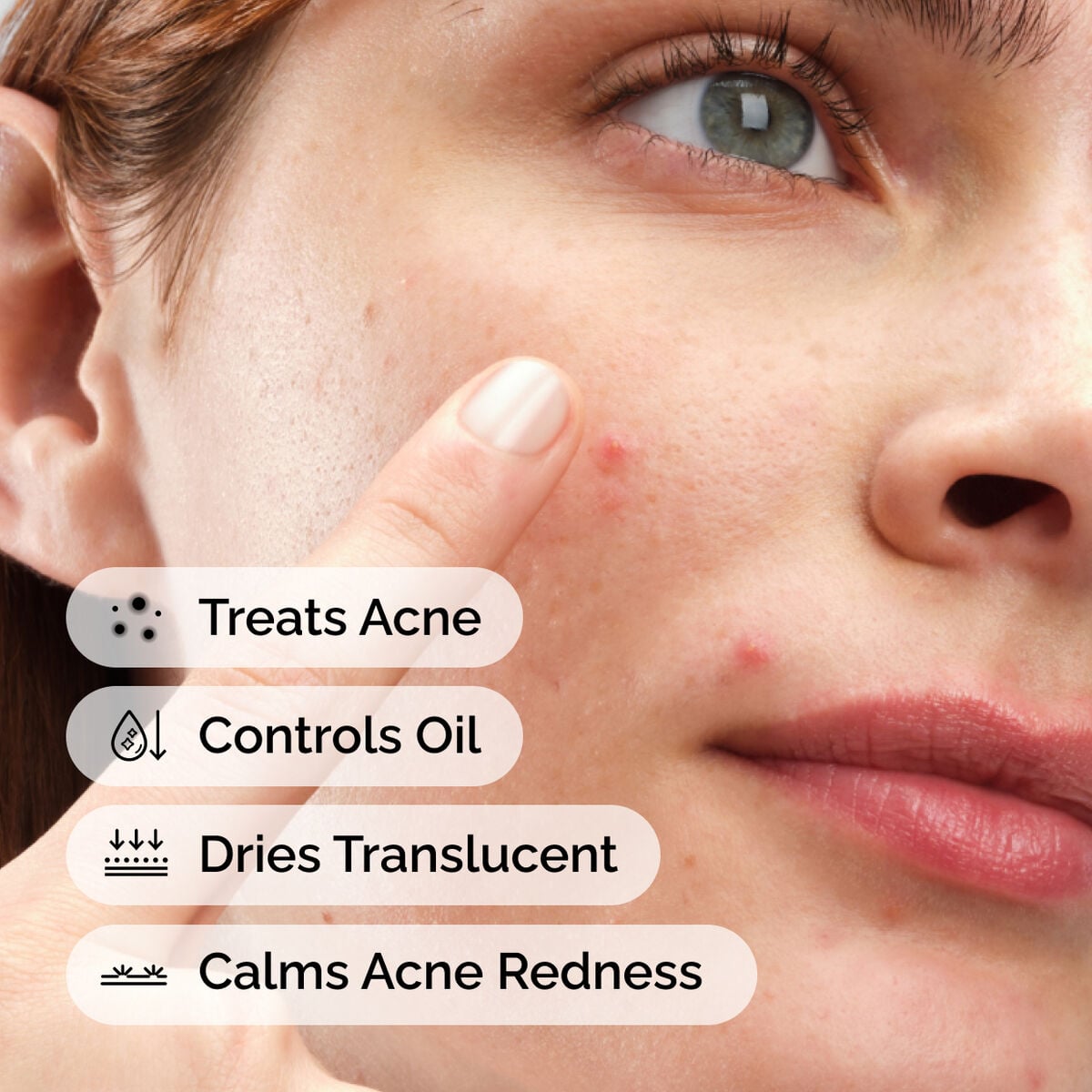 sulfur-10-powder-to-cream-concentrate-t5 ord-sulfur-10pct-powder-to-cream-concentrate-model-application-with-benefits-acne.jpg